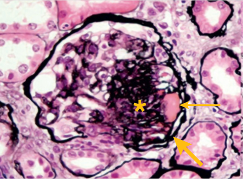 pathology in IgA