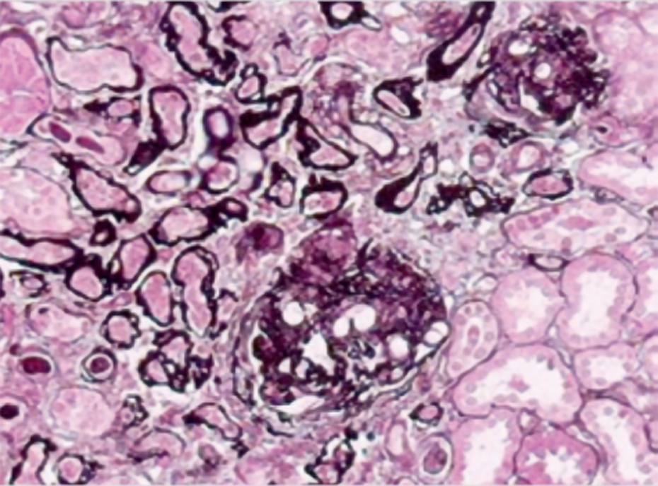 pathology in IgA