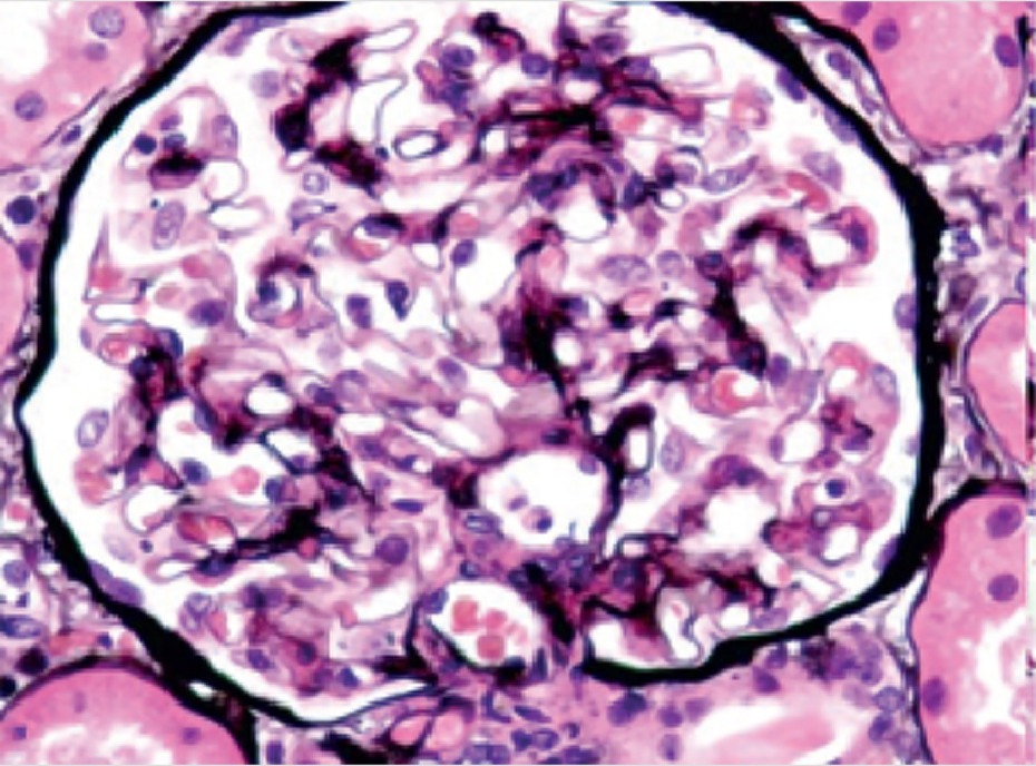 pathology in IgA