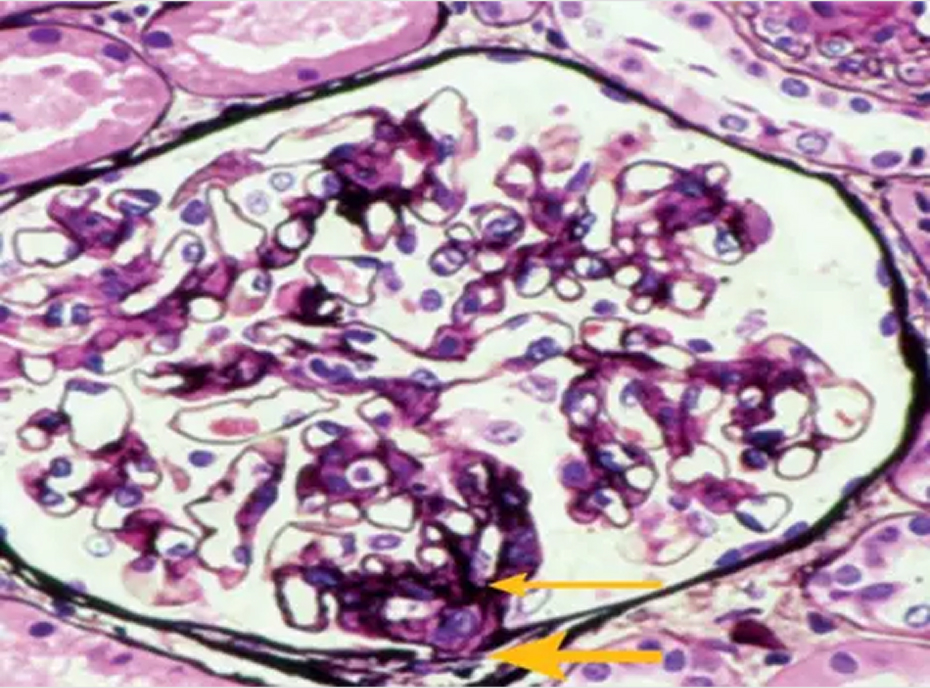 pathology in IgA