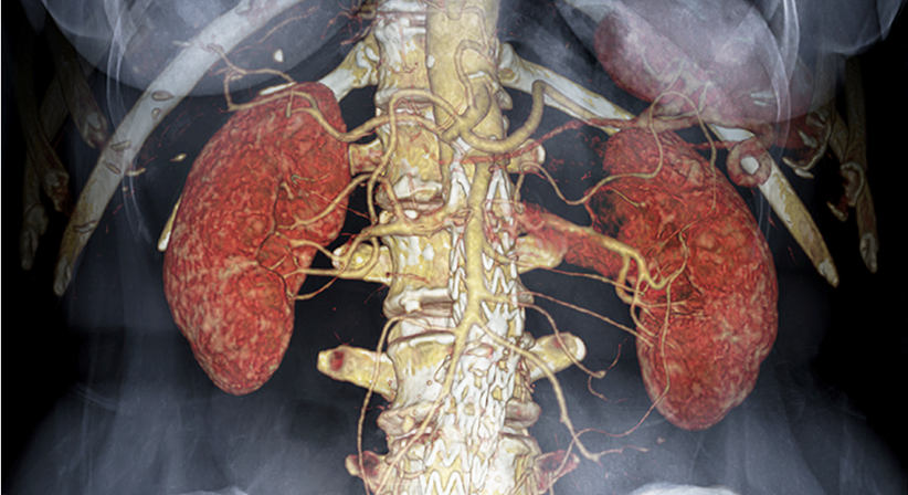 Separating Fact from Fiction: The Realities of CKD-aP
